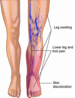 Deep Vein Thrombosis - Early Symptoms, Signs, Causes & Treatments Leg Veins, Vein Thrombosis, Arteries And Veins, Leg Pain, Shortness Of Breath, Chest Pain, Skin Discoloration, Blood Vessels