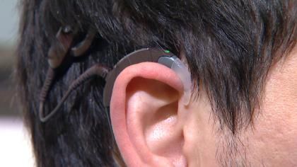 New Cochlear Implant Technology Gives Deaf People A New Ear Cochlear Implant Aesthetic, Twice Exceptional, Cochlear Implants, Cramps Relief, Cochlear Implant, Hearing Health, Texas Roadhouse, Lone Tree, Character Aesthetics