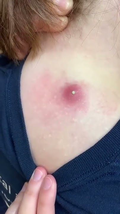 Satisfying Acne Removal Videos, Lip Blackheads, Dr Pimple Popper Youtube, Pimple Removal Video, Blackheads Removal Satisfying Videos, Blackheads On Back, Lip Pimple, Michael Fassbender And Alicia Vikander, No Face Body Pictures