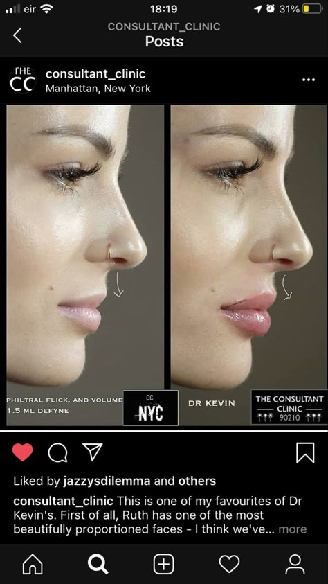 Lip Fillers Side Profile, Lip Filler Side Profile, Lip Filler Before And After, Natural Lip Fillers, Lip Filler Inspiration, Nose Surgery Rhinoplasty, Dermal Fillers Lips, Lip Surgery, Lips Inspiration