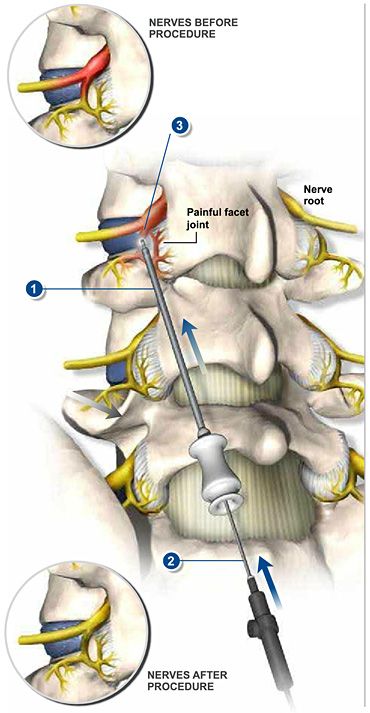 #Rhizotomy reduces or eliminates the pain of damaged facet joints by disrupting the medial branch nerves that carry the pain signals. This procedure is performed with local anesthetic. #spine #health http://www.southeasternspine.com/procedures-treatments/rhizotomy/ Angie Harmon, Back Pain Remedies, Cervical Spine, Nerve Pain Relief, Sciatica Pain, Knee Pain Relief, Neck And Back Pain, Joints Pain Relief, Invisible Illness