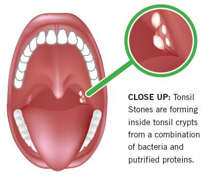 TheraBreath offers solutions & prevention for bad breath, dry mouth, tonsil stones, canker sores & more! Shop now and stop your bad breath today! Mouth Sore, Tonsil Stone Removal, Tonsil Stone, Scratchy Throat, Magnesium Benefits, Canker Sore, Dry Mouth, Healthy Teas, Creating A Newsletter