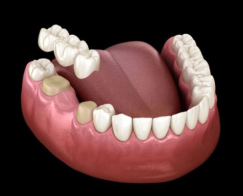 A dental bridge helps bridge the gap created by one or more missing teeth. - Click the link to learn more about the Types, Benefits, Costs ! Tooth Bridge, Dental Bridge Cost, Dental Wallpaper, Dental Images, Dental Posts, Tooth Repair, Dental Aesthetics, Best Dental Implants, Human Teeth