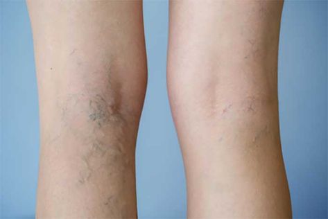 Spider veins and varicose veins can easily be confused with one another. Spider veins (right) are red or purple in color and tend to be smaller and flatter. Varicose veins (left) are usually blue, bigger, and bulge out on the legs. Image: Vein Clinics Skin Lightening Lotion, Visible Veins, Leg Veins, Fruit Recipes Healthy, Lightening Serum, Green Veins, Stretch Mark Removal, Calf Muscles, Health Issues