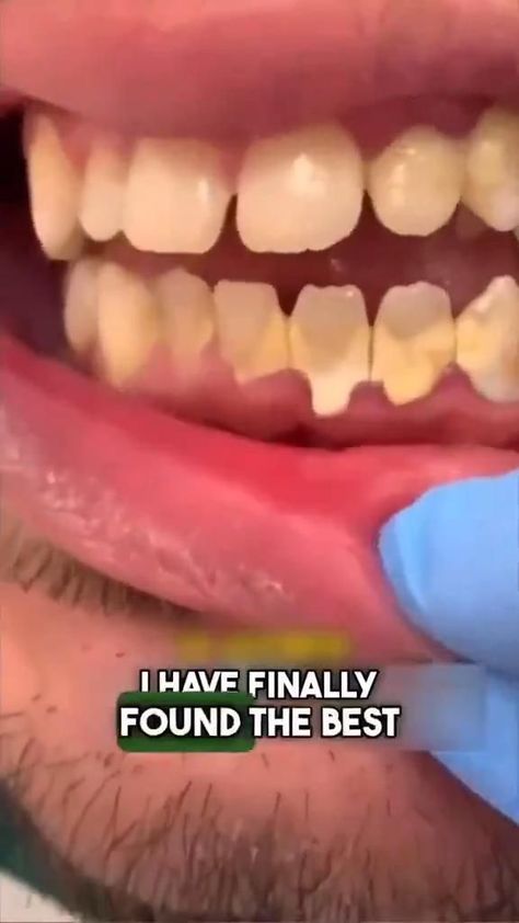 Natural Teeth Whitening Diy, Home Teeth Whitening, Banana Peels, Teeth Whitening Homemade, Whitening Teeth, Teeth Whitening Diy, Whiten Your Teeth, Diy Skin Care Routine, Teeth Health