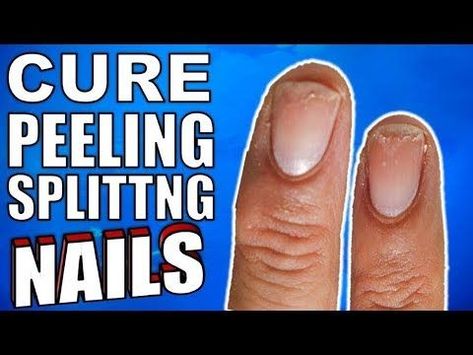 Why Are Your Nails Peeling & Splitting ? |How to Stop It For Good Dealing with weak, brittle, peeling nails is a super frustrating issue. Not only does nail polish chip faster, but it's also super painful when you reach for something and your nails actually bend.  It affects upto 20 percent of the population Some health conditions can result in peeling of both fingernails and toenails, but if only your fingernails are affected, the cause is likely to be external. How To Stop Nails From Peeling, Splitting Nails Remedies, Peeling Nails Remedy, Finger Nails Health, Splitting Fingernails, Peeling Fingernails, Fingernail Health, Nail Remedies, Healing Guide