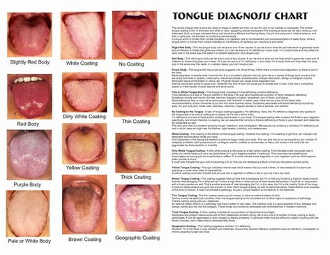 Image Chinese Medicine Tongue Diagnosis, Cracked Tongue, Yellow Tongue, Qi Deficiency, Tongue Sores, Remedies For Dry Mouth, Dairy Free Breastfeeding, When To Plant Vegetables, Swollen Tongue