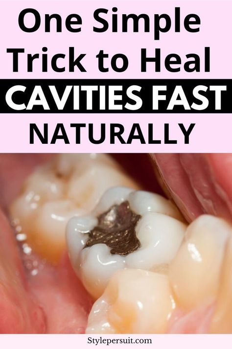 back pain home remedies Home Remedies For Cavities, Cavity Remedy, Tooth Cavity, Tooth Decay Remedies, Remedies For Tooth Ache, Tooth Repair, Heal Cavities, Teeth Health, Tooth Pain