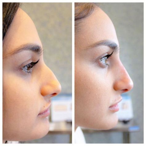 One girl documented her experience of getting a liquid nose job, and the before and after photos are pretty telling. Contour Nose Side Profile, Nonsurgical Nose Job Before And After, Hair For Big Nose, Haircuts For Big Noses, Dream Nose, Nonsurgical Nose Job, Lip Job, Nose Fillers, Rhinoplasty Nose Jobs