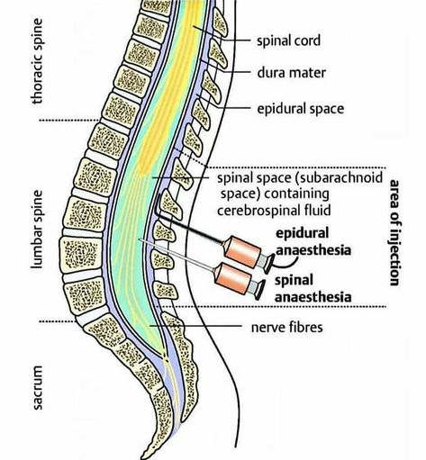 Medical Case Presentation on Instagram: “Epidural and spinal #anesthesia are types of anesthesia in which a local anesthetic is injected near the spinal cord and nerve roots.…” Anesthesia School, Nurse Anesthesia, Sciatica Symptoms, Case Presentation, General Anaesthesia, Nerve Fiber, Sciatica Exercises, Spinal Nerve, Sciatica Pain Relief