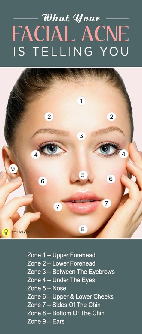 What Your Facial Acne Is Telling You #facial #facial #acne What Your Acne Is Telling You, Pimples Between Eyebrows, Eyebrow Acne, Acne Between Eyebrows, Face Cleaner, Get Rid Of Pimples, Rid Of Pimples, Acne Overnight, Pimples Overnight