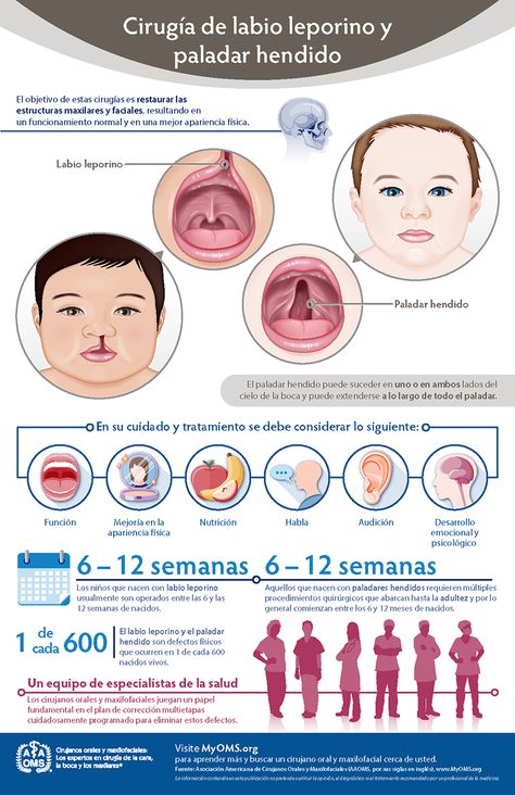 Cleft lip surgery is usually performed by the time an infant is 3 months old. By contrast, a cleft palate often requires multiple surgeries over the course of 18 years. Infographic in Spanish. Professional Boundaries, Ent Clinic, Lip Surgery, Cleft Lip And Palate, Cleft Palate, Dentistry Student, Cleft Lip, Nurse Art, Loose Tooth