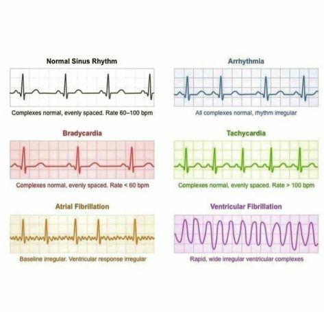 Heart Physiology, Arterial Line, Er Tech, Ekg Interpretation, Normal Sinus Rhythm, Air Force Day, Medical Study, Basic Anatomy, Basic Anatomy And Physiology