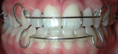 .
#healthyteethtips #dentalhealthcare Hawley Retainer, Braces Retainer, Retainer Teeth, After Braces, Clear Retainers, Teeth Aesthetic, Esthetic Dentistry, Cute Braces Colors, Teeth Tips