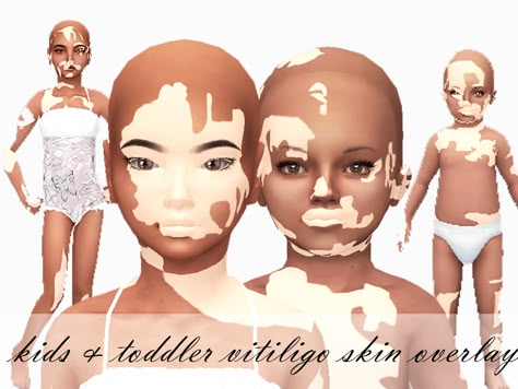 ForeverXXSims_Child&ToddlerVitligo_Merged Sims 4 Cc Vilitigo Skin Infant, Jay Sims Skin, Sims 4 Smooth Skin, Sims 4 Cc Toddler Skin Overlay, Sims 4 Cc Child Body Preset, Sims 4 Vilitigo Cc, Sims 4 Cc Kids Body Presets, Sims 4 Toddler Skin Details, Mom Sims 4 Cc