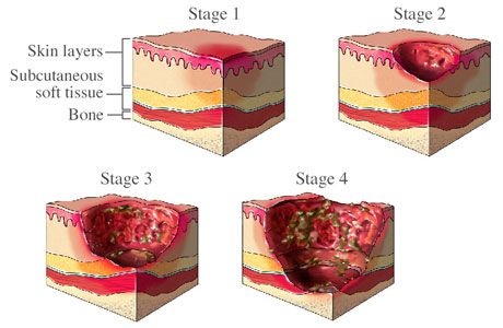 Mrsa Skin Infection in animals | Bed Sores - prevention and care Wound Care Nursing, Bed Sores, Pressure Ulcer, Nursing Tips, Wound Care, Natural Home Remedies, Natural Gifts, Natural Treatments, Home Health