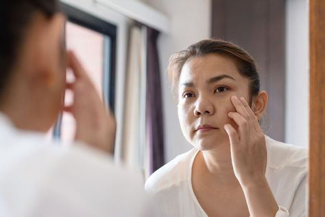 Calcium Deposits on the Face: Symptoms and Causes Calcium Deposits On Face, Natural Wrinkle Reducer, Home Remedies For Wrinkles, Calcium Deposits, Skin Growths, Face Wrinkles, Skin Dryness, Skin Disorders, Laser Therapy