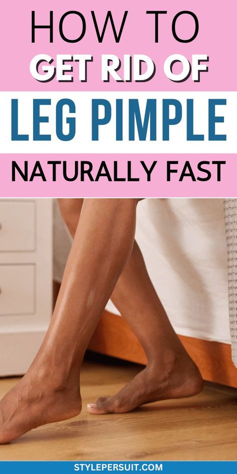 How to Get Rid of Leg Pimples Leg Pimples, Bumps On Legs, Leg Acne, Calamine Lotion, Strawberry Legs, Heat Rash, Acne Vulgaris, Diy Body Scrub, How To Get Rid Of Pimples