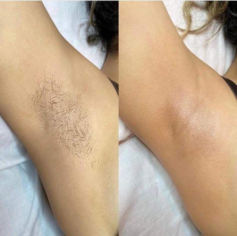 Underarm Waxing, Esthetician Inspiration, Wax Photos, Underarm Odor, Hair Eraser, Underarm Hair Removal, Painless Hair Removal, At Home Hair Removal, Body Waxing