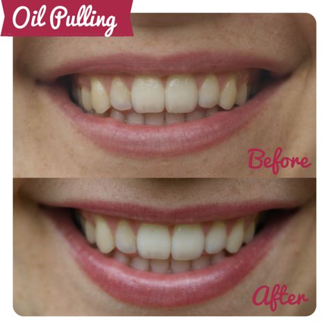 Can oil pulling for a fortnight transform your teeth? Oil Pulling Teeth Whitening, Coconut Oil Pulling Teeth, Oil Pulling Benefits, Beauty Myth, Coconut Oil For Teeth, Whiten Teeth, Coconut Oil Pulling, Oil Pulling, Benefits Of Coconut Oil