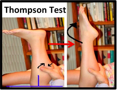 Tight Achilles Tendon Stretches, Ruptured Achilles, Torn Achilles Tendon, Achilles Tendon Ruptures, Achilles Pain, Homemade Medicine, Calf Pain, Achilles Tendon, Trigger Points