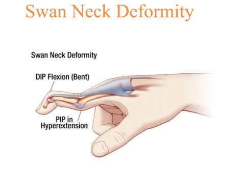 Swan Neck Deformity Swan Neck Deformity, Learn Medicine, Nbcot Exam, Ortho Nurse, Mallet Finger, Np School, Medical School Life, Nurse Student, Medical Student Study