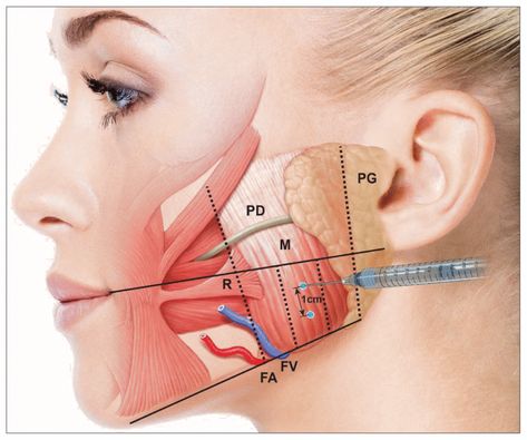 How Botox can be used for Face Slimming - Boss Gal Beauty Bar Face Injections, Botox Injection Sites, Botox Training, Facial Injections, Injection Sites, Aesthetic Nursing, Botox Injection, Botox And Fillers, Aesthetic Nurse