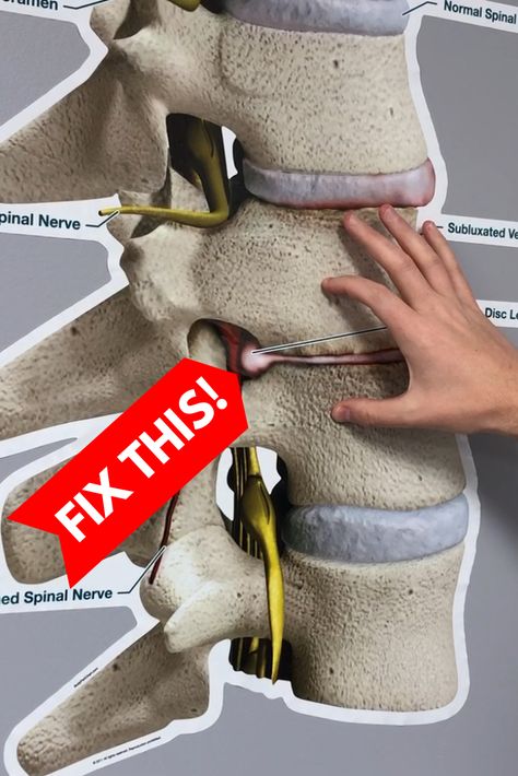 Bulging Disc Exercises, Dr Rowe, K Tape, Stomach Exercises, Back Relief, Bulging Disc, Sciatica Exercises, Pinched Nerve, Sciatica Pain Relief