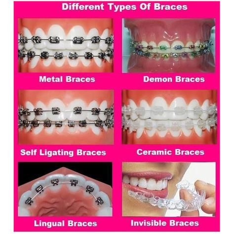 The most commonly used bracket braces are metal braces and ceramic braces. It is best to schedule an appointment with an orthodontist, as he can recommend the type of braces that a person should be wearing. Different Types Of Braces, Braces Before And After, Damon Braces, Lingual Braces, Braces Pain, Ceramic Braces, Cute Braces Colors, Types Of Braces, Adult Braces