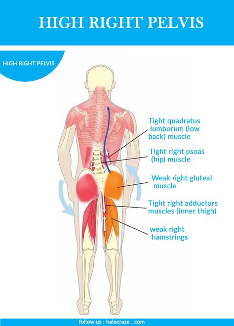 High Right Pelvis Facts. #health #fitness #pelvis #facts #muscle #hip #muscle #quadratus #hamstring Lateral Pelvic Tilt, Knee Health, Gluteal Muscles, Pelvic Tilt, Muscle Anatomy, Hip Muscles, Easy Yoga Workouts, Health Knowledge, Back Muscles