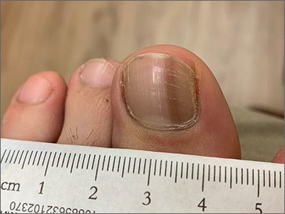 Dark toenail line Dark Toenails, Brown Pedicure Ideas, Nail Black, Popular Nail Designs, Lines On Nails, Brown Line, Family Medicine, Skin Clinic, Dark Nails