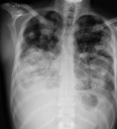 Lung metastases - Radiology at St. Vincent's University Hospital Lung Xray, Lung Function Test, Mri Ct Xray, Chest X Ray Radiology, Medical Radiography, Pleural Effusion, Mri Brain, Lung Transplant, Radiology Imaging