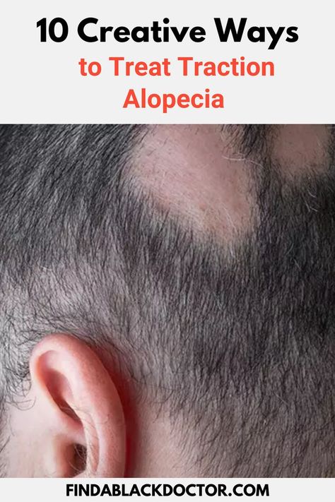 Creative Ways to Treat Traction Alopecia Black Doctor, Alopecia Hairstyles, Traction Alopecia, Healthier Hair, Hair Transplant, Healthy Hair, A Black, Health And Wellness, Health