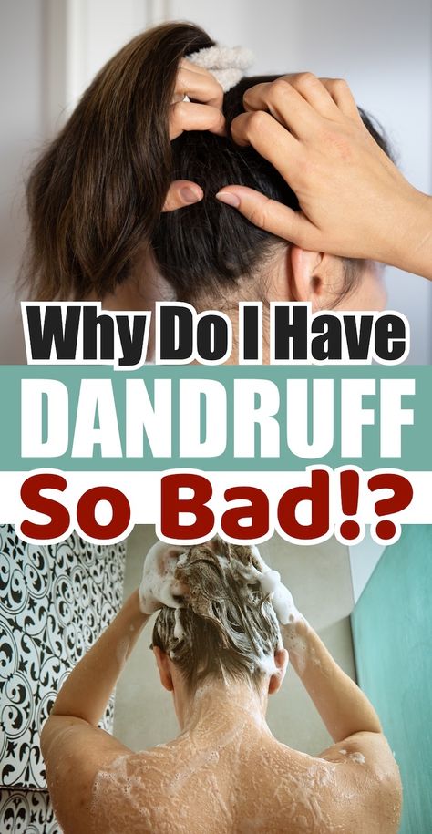 How To Prevent Dandruff, Bad Dandruff, What Causes Dandruff, Best Shampoo For Dandruff, How To Remove Dandruff, Severe Dandruff, Natural Dandruff Remedy, Hair Mask For Dandruff, Dandruff Causes