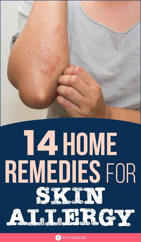 Allergic Reaction Remedies, Skin Rash Remedies, Home Remedies For Rashes, Allergy Rash, Rashes Remedies, Natural Antihistamine, Remedies For Skin, Home Remedies For Allergies, Natural Remedies For Allergies