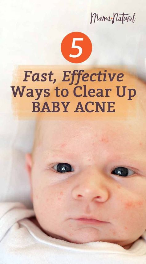 You're about to set up a newborn photo shoot when you notice zits on your baby's face ? Learn what causes baby acne and how to treat it! https://www.mamanatural.com/baby-acne/ Baby Acne Remedy, Newborn Acne, Baby Acne, Pregnancy Info, Mama Natural, Pregnancy Information, Pumping Moms, Fantastic Baby, Baby Sleep Problems