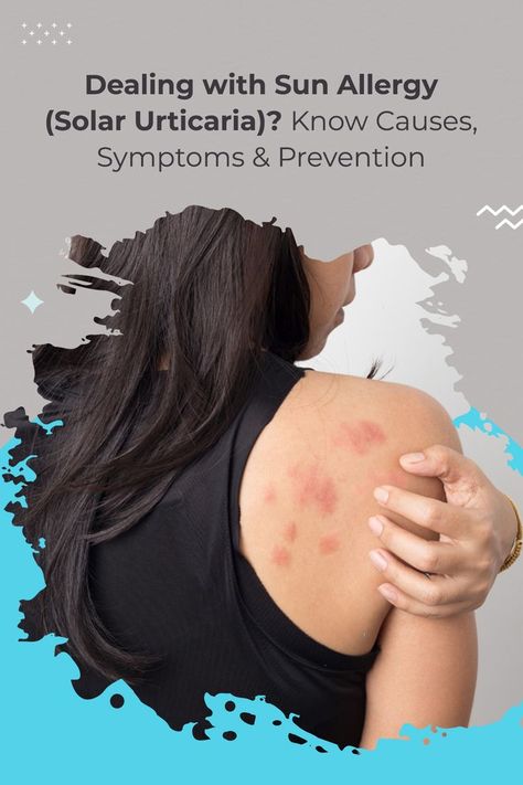 Skin Problems in Summer - Sun Allergy Sun Allergy, Hair Academy, Sick Remedies, Allergy Remedies, Red Patch, Skin Condition, Allergy Symptoms, Coping Strategies, Skin Conditions