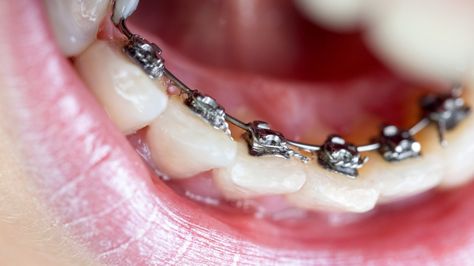 Lingual Braces: Pros and Cons, Cost, Comfort, Lisping, and More Permanent Retainer, Braces Color Wheel, Braces Before And After, Fixed Braces, Lingual Braces, Braces Cost, Types Of Braces, Adult Braces, Traditional Braces