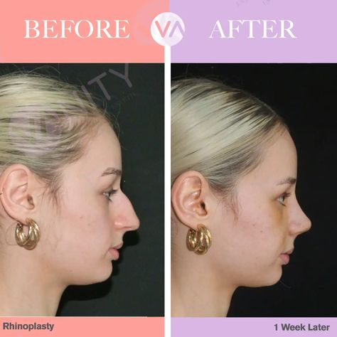 Rhinoplasty Turkey - All Inclusive Nose Job in Turkey Cost 2023 | Vanity Turkey Nose Job, Rhinoplasty Turkey, Nose Job, Plastic Surgery, All Inclusive, Surgery, Vanity, Dressing Table