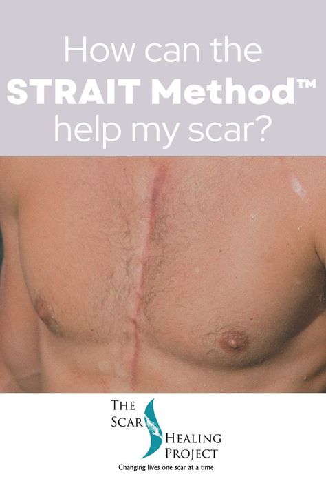 STRAIT Method™ therapy begins with a series of fascial techniques that release and realign the restrictive tissue from the starting point (visible scar) to the endpoint (where the line of frozen fascia stops). You experience relief from the years of pain you’ve endured by finally addressing your adhesions and scars. #thescarhealingproject #scars #straitmethod #massagetherapy #massage #clinicalmassage #scartissuerelease #scartherapy #healingfromscars Scar Tissue Massage, Body Mechanics, Scar Tissue, Balanced Life, Finding Balance, Holistic Approach, Healing Journey, Massage Therapy, Mental Wellness