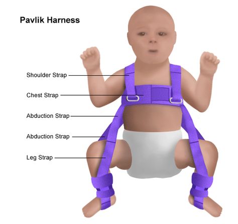 Pavlik harness Hip Dysplasia Baby, Developmental Dysplasia Of The Hip, Pavlik Harness, Baby Harness, Nursing Board, Fundamentals Of Nursing, Hip Dysplasia, Nursing Baby, Nursing Notes