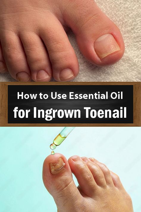 How to Use Essential Oils for Ingrown Toenail Diy Ingrown Toenail Remedy, How To Get Rid Of Ingrown Toenails, How To Treat Ingrown Toenail, Ingrown Toenail Remedy, Ingrown Toenail Remedies, Toenail Pain, Toenail Health, Nail Remedies, Ingrown Toenail