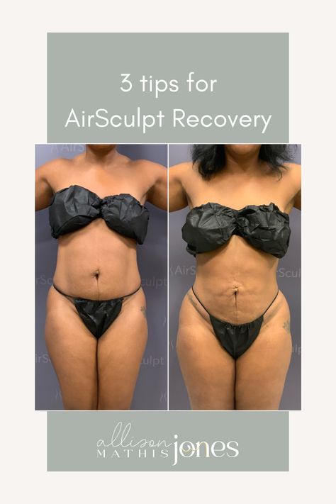 I recently had AirSculpt liposuction done and am in love with the results. Here are my tips for recovery in the first 90 days! Air Sculpting Before And After, Airsculpt Before And After, Self Care For Kids, Self Care Day Routine, Self Care Day Ideas, Self Care Must Haves, Self Care Tracker, First 90 Days, Body Contouring Surgery