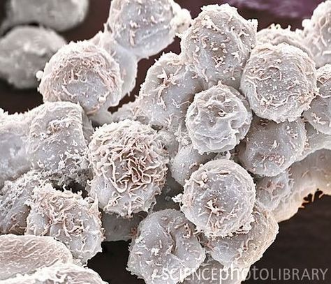 White blood cells. Coloured scanning electron micrograph (SEM), showing white blood cells present in a urine sample taken from someone with a urinary tract infection (UTI). The number of white blood cells in urine sediment is normally low. When the number is high, it indicates an infection or inflammation somewhere in the urinary tract. Magnification: x2600 when printed to centimetres wide. Linking Arms, Medical Images, White Blood Cell, Cells Project, Scanning Electron Micrograph, Microscopic Photography, Microscopic Images, Electron Microscope, White Blood