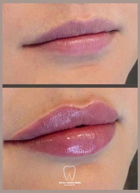 Lip Filler Shapes Chart, Small Lip Injections, Full Natural Lips, Minimal Lip Fillers Before And After, Lip Filler Types, Types Of Lip Filler Shapes, Lip Fillers Before And After 1ml Small Lips, Lip Filler Inspiration Russian, Lip Filler 1 Syringe