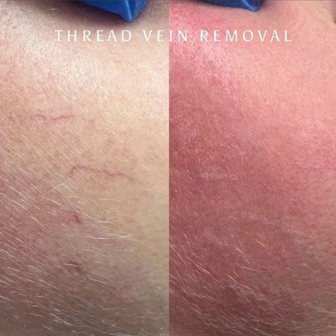 Belle Clinic London offer Veinwave/Laser/ Micro Sclerotherapy to remove Thread Veins/ Spider Veins/blood vessels effectively & cost effectively. 0% Finance available. Call today to book in. ☎️ 020 8936 7686 📲 07455 404141 📧 Email us info@belleclinic.co.uk 1 Golsers Green Road, London, NW11 8DY #Veinwave #laser #bloodvessels #threadveins #threadveinsremoval #spiderveins #skintreatment #skinclear Laser Hair Removal Upper Lip, Fractional Laser Before After, Laser Scar Removal Before And After, Thread Veins, Laser Vision Correction, Kenzzi Ipl Laser Hair Removal Handset, Skin Aesthetics, Blood Vessels, Skin Treatments