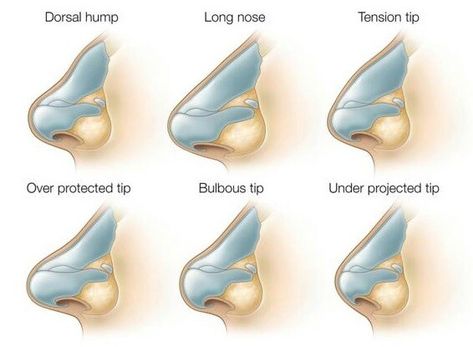 Pimple Inside Nose, Acne On Nose, Nose Surgery Rhinoplasty, Anatomy Head, Nose Types, Rhinoplasty Nose Jobs, Nose Reshaping, Rhinoplasty Surgery, Pretty Nose