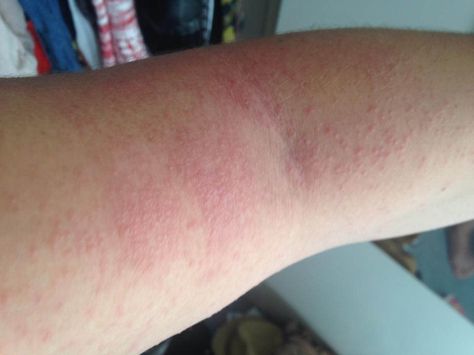 Hives skin reaction and rash | Flickr - Photo Sharing! Allergy Hives, Hives Rash, Sick Remedies, Peanut Allergy, Dark Underarms, Skin Allergies, Allergic Reaction, Natural Home, Food Allergies