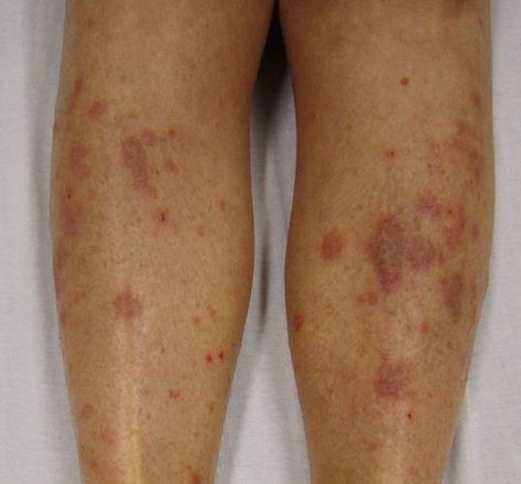 What is the Difference Between Lichen Planus and Lupus Erythematosus Check more at https://in4arts.com/what-is-the-difference-between-lichen-planus-and-lupus-erythematosus.html Lichen Planus, Hypertrophic Scars, Homeopathy Medicine, Wheat Belly, Scar Tattoo, Food Allergy, Skin Disorders, Tattoo Removal, Alternative Health