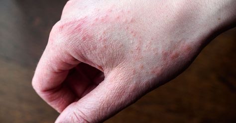 Eczema giving you hell? Experts offer advice on how to ease pain caused by common skin condition - Mirror Online http://www.mirror.co.uk/lifestyle/health/eczema-giving-you-hell-experts-11263362 Heat Rash Remedy, Rash On Hands, Rashes Remedies, Heat Rash, Body Treatments, Sensitive Skin, Salt, Skin